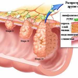 Što je prvi simptom raka debelog crijeva?
