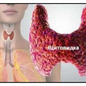 Autoimuni tiroiditis ili Hashimotov tiroiditis je štitnjača