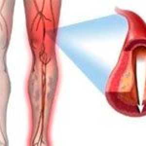 Ateroskleroze donjih ekstremiteta (noge)