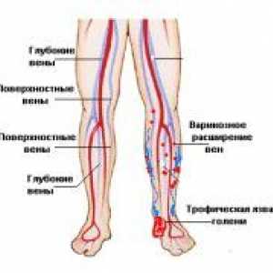 Ateroskleroze donjih udova: postupci liječenja bolesti