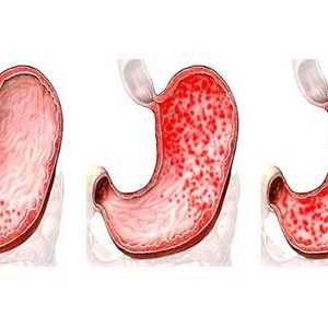 Pregled erozivnog gastritisa