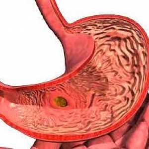 Focal gastritis - lezija želučane sluznice površina