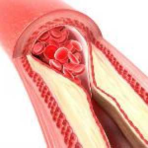 Okluzija arterija