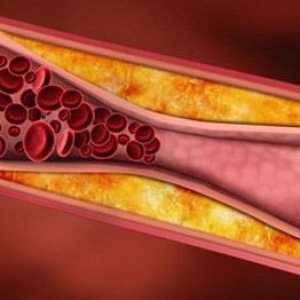 Okluzije (opstrukcije krvnih žila) - znatna manifestacija vaskularne insuficijencije