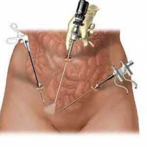 Kirurgija za uklanjanje fibroids maternice