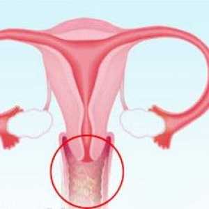 5 Glavni uzrok infekcije kvasca u žena