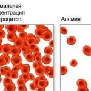 Glavni uzroci anemije