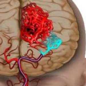 Glavni znakovi ishemijskog moždanog udara