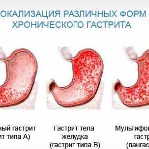 Obilježja antralnog gastritisa i postupci liječenja