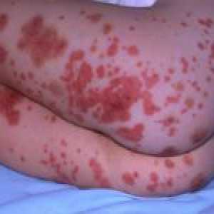 Značajke hemoragične vaskulitisa u djece