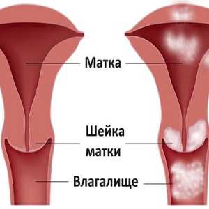 Značajke menstruacija rak maternice i jajnika
