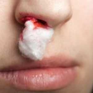 Uzroci krvarenja iz nosa, prvu pomoć i prevencija
