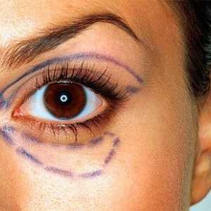 Značajke transkonjuktivne Blefaroplastika oka