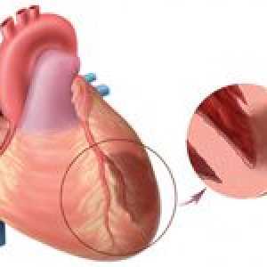 Značajke infarkta miokarda i njegovo liječenje