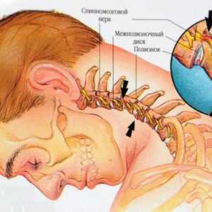 Osteochondrosis od vratne kralježnice