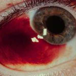 Zašto su slomljena žile u očima