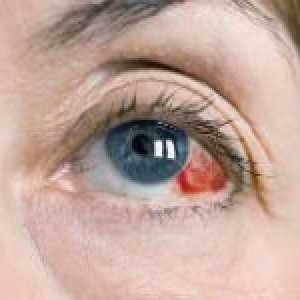 Zašto praska krvne žile u očima: glavne razloge