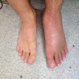 Oteklina nakon ozljede stopala
