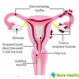 Endometrioza 1 stupanj