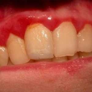 Parodontne bolesti: simptomi, uzroci i liječenje