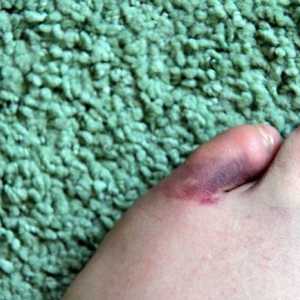 Fraktura malog prsta na nozi: Simptomi i liječenje