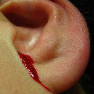Zašto je krvarenje iz uha