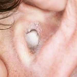 Zašto se i kako liječiti gljivice u ušima?