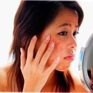 Tinejdžerski akne - kako izliječiti acne vulgaris?
