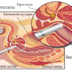 Indikacije za biopsiju prostate i tehnologije njegove provedbe