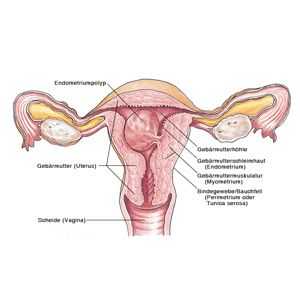Polipi i endometrioza: što je ispunjen s ovom kombinacijom?