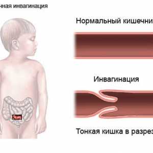 Posljedice crijeva opstrukcije u dojenčadi