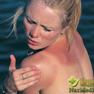 Praktični narodnih lijekova za sunčanje opeklina i prve pomoći kad se pojave
