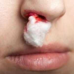 Uzroci čestih krvarenja iz nosa i načinu zaustavljanja