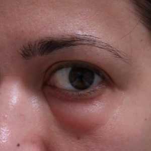 Uzroci i liječenje natečen oči
