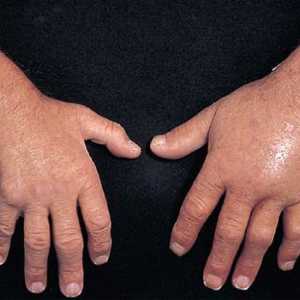 Uzroci i liječenje ruku edema
