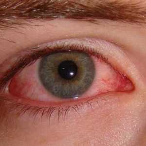 Uzroci i liječenje alergijske oka edema