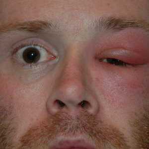 Uzroci oteklina očiju i gornji kapak