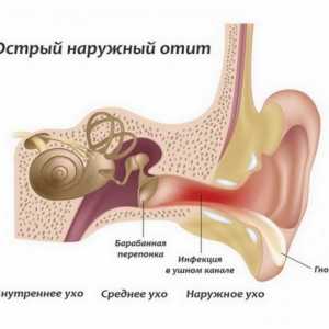 Uzroci simptomi i liječenje upale srednjeg uha uha