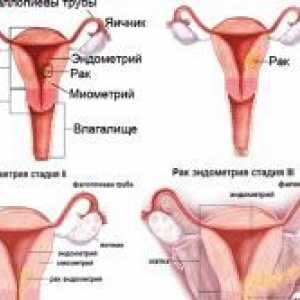 Uzroci i liječenje hiperplazije endometrija maternice