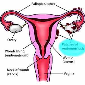 Uzroci endometrioze, - razmotriti sve teorije