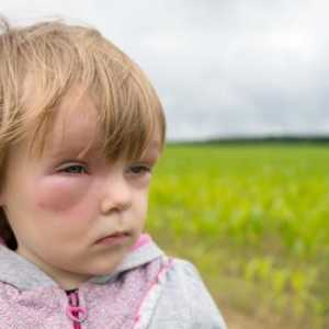 Pomoć u anafilaktički šok kod djece