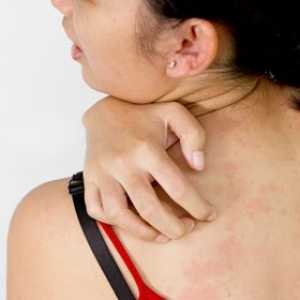 Uzroci svrbež kožu tijela