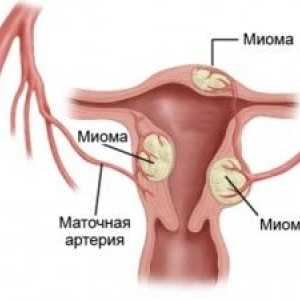 Upotreba folne kiseline u mioma maternice