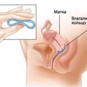 Primjena ginekološki prsten sa 4 prolapsa maternice