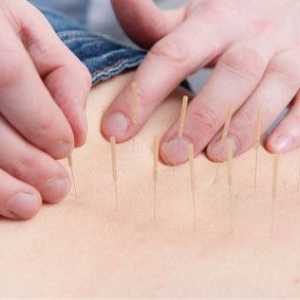 Upotreba akupunktura za leđne kila