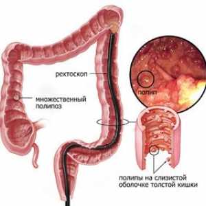 Simptomi i liječenje polipa u crijevima