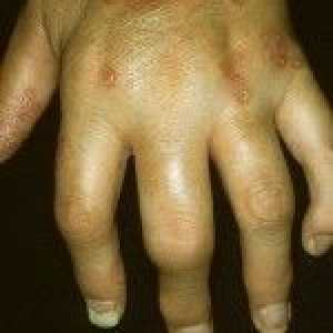 Psorijatični artritis