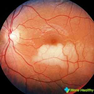 Stratifikacija mrežnice očiju: uzroci i posljedice