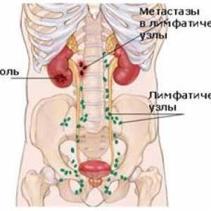 Raznolikost i liječenje abdominalne adenopatiju
