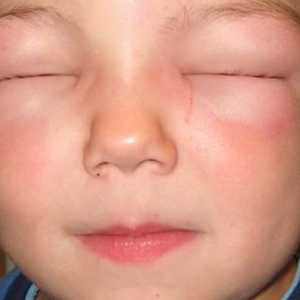 Manifestacije i liječenje angioedema u djece